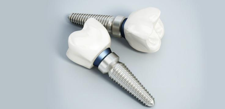 Dental implants with white ceramic crowns and metal titanium screws on gray background.