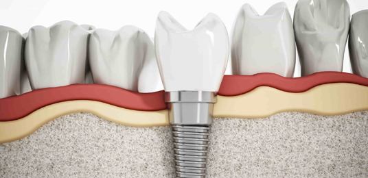 Dental implant Oceanside