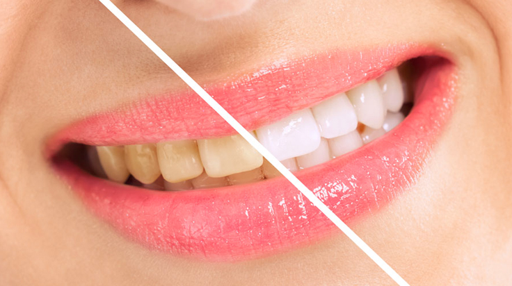 Teeth Whitening Oceanside