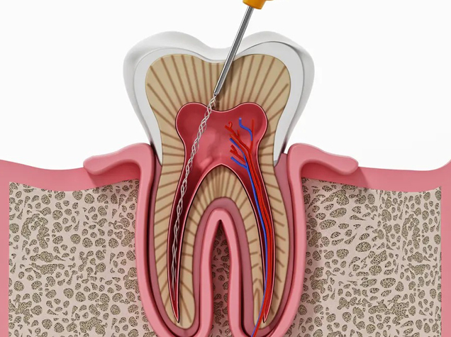 Root canal treatment Oceanside