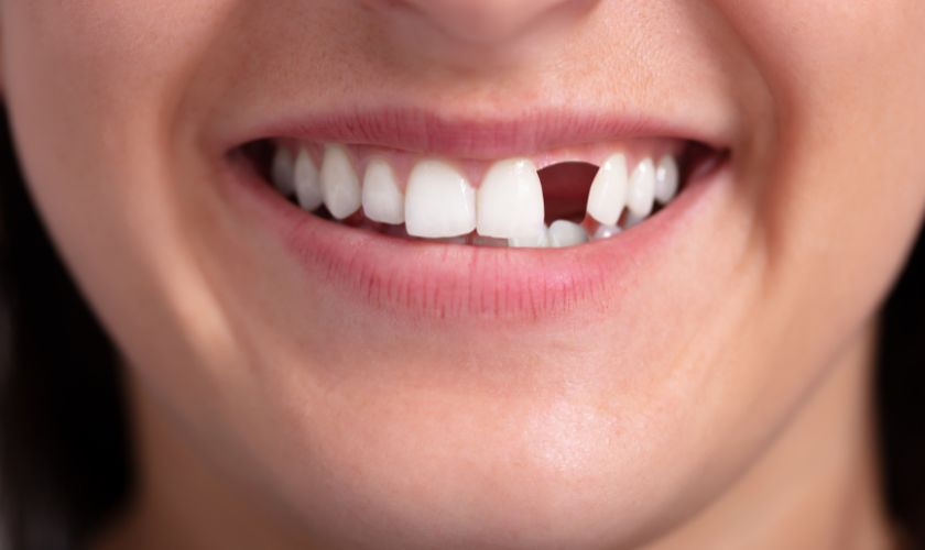 Missing Teeth