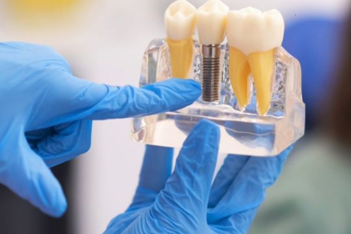 Dental implants in Oceanside