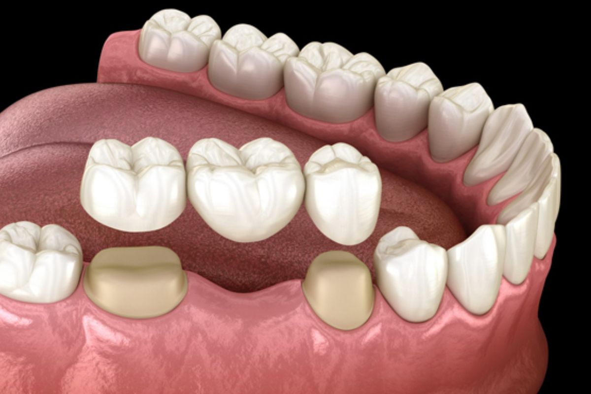 dental-bridges