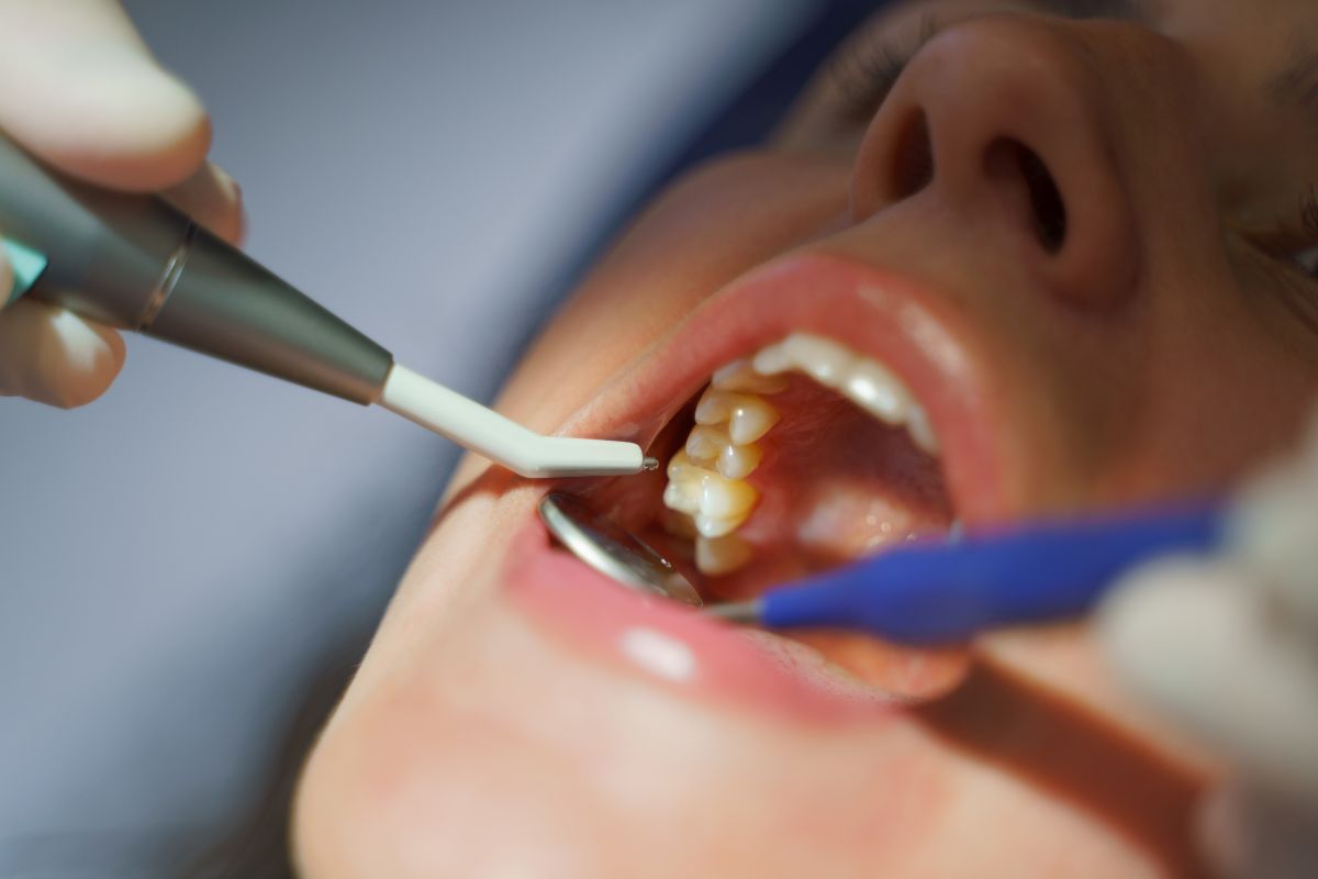 dental cleanings