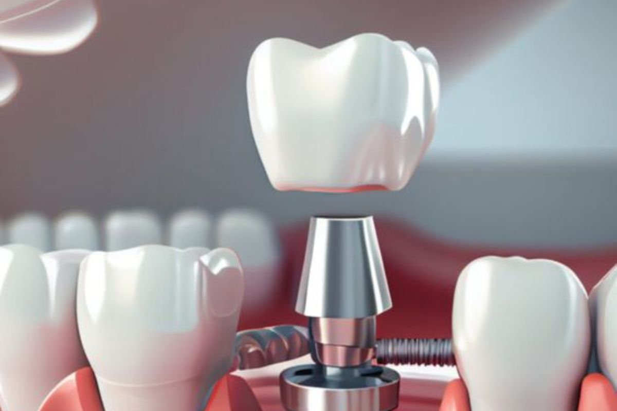 Dental implants oceanside