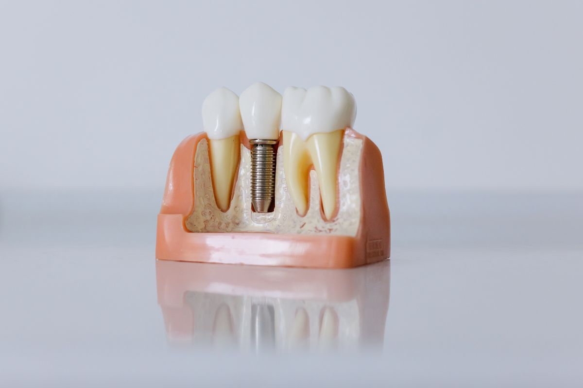 Dental implant in Oceanside