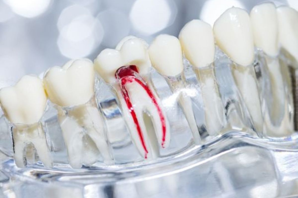 Root canal treatment in Oceanside