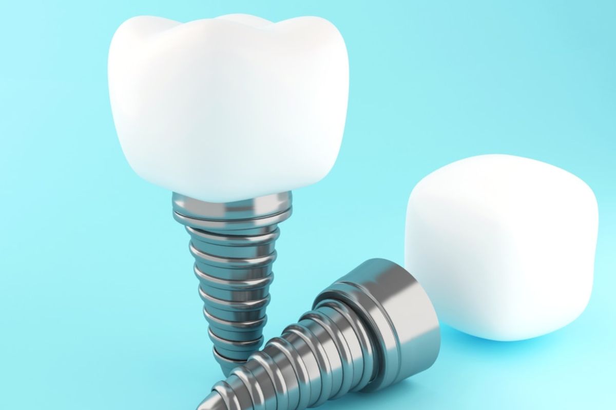 Dental Implants
