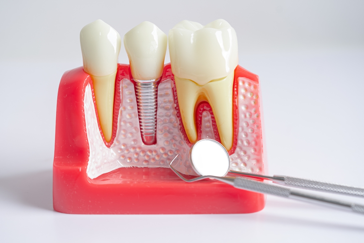 How to Maintain Your Dental Implants for a Lifetime