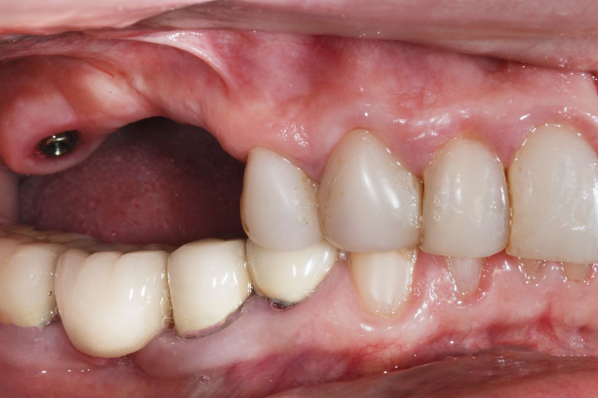 Dental Implants for the Upper Jaw: Unique Challenges and Effective Solutions