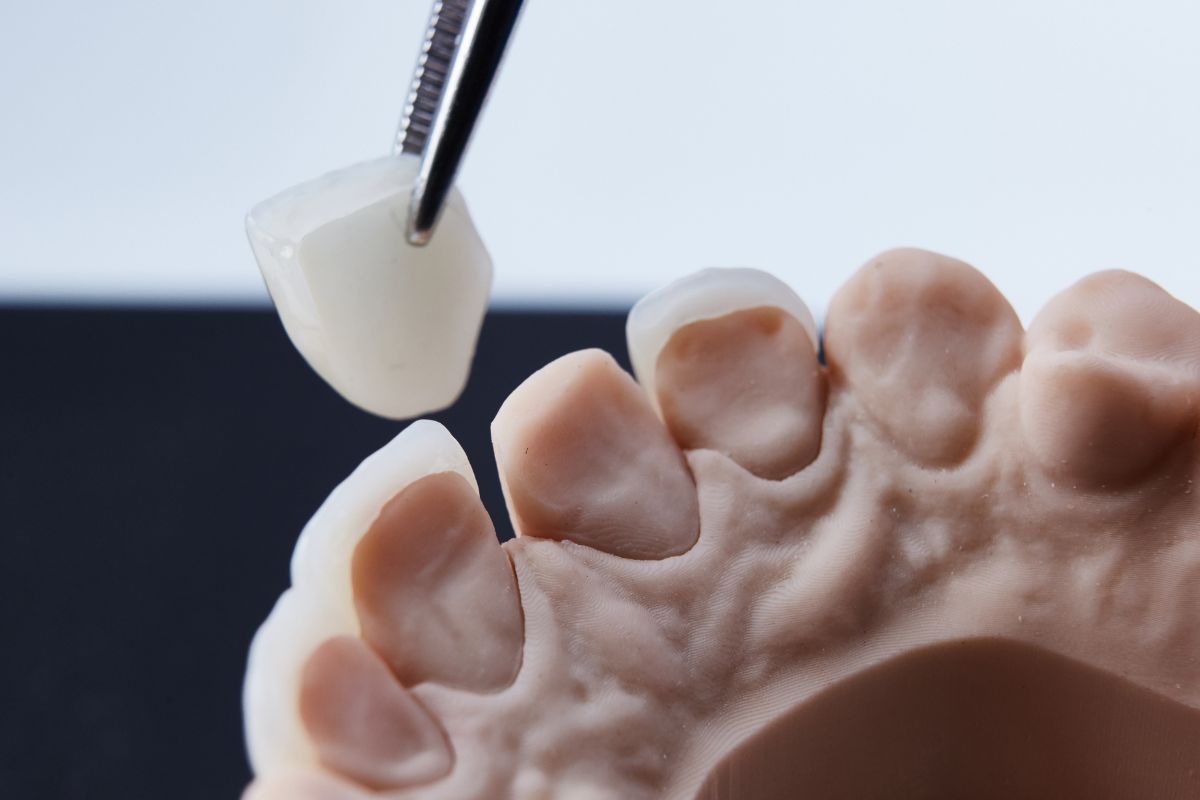 Fixing Gapped Teeth with Dental Veneers: A Non-Orthodontic Option