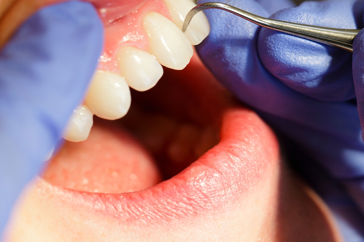 How Dental Cleanings Help Prevent Gum Disease