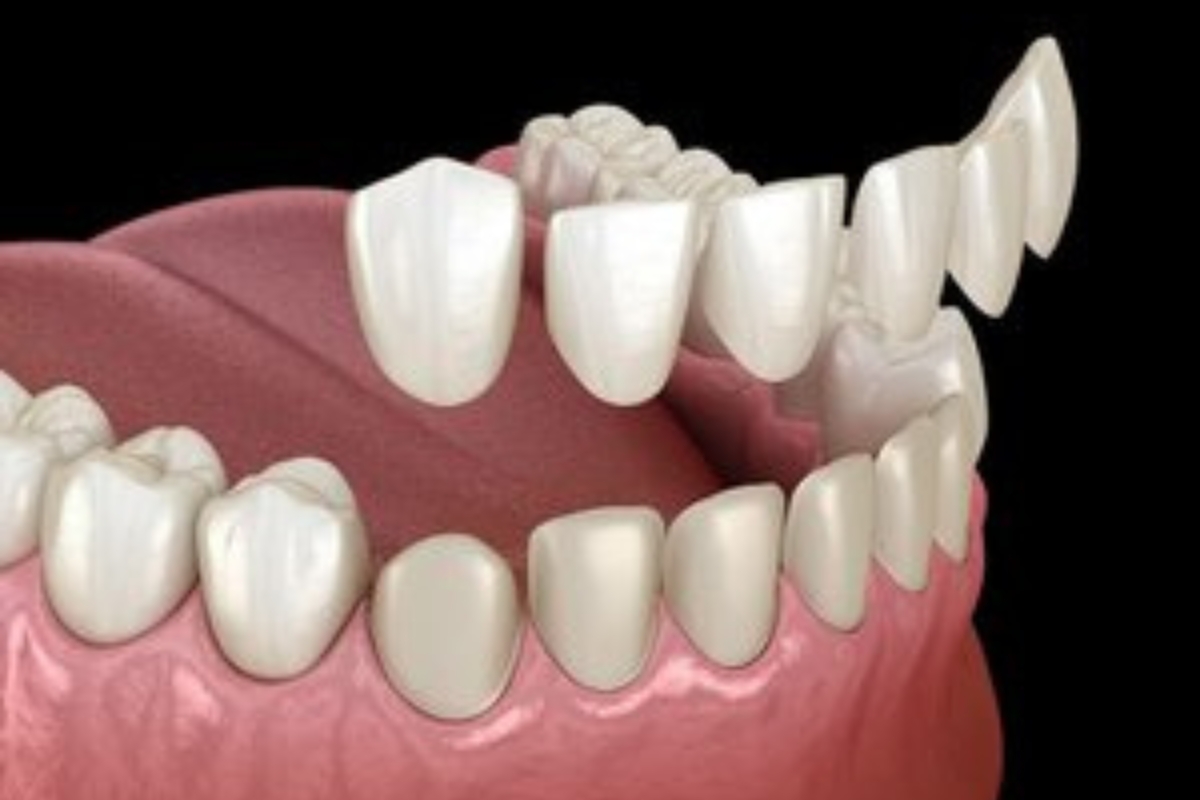 Choose Dental Veneers Over Other Treatments for Chips and Gaps