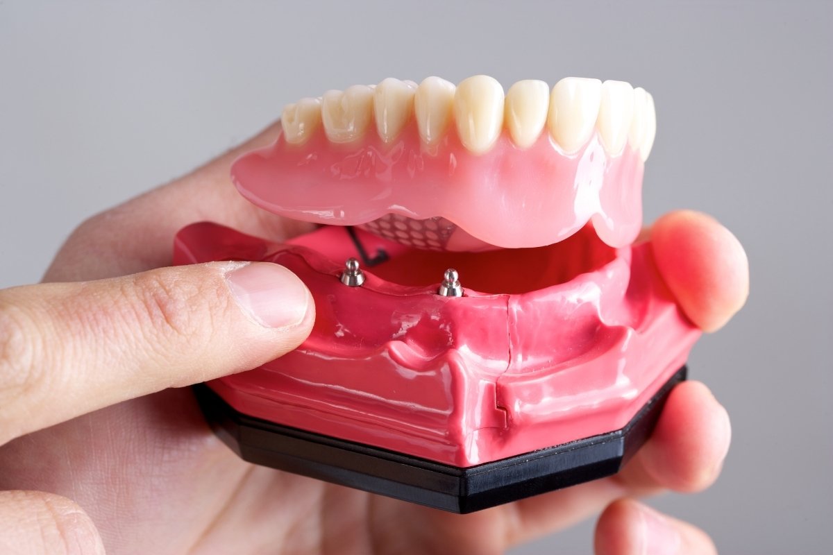 most significant advantages of implant-supported dentures