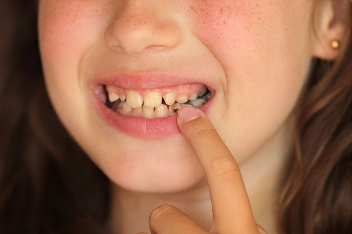 How Dentists Detect and Treat Early Tooth Decay