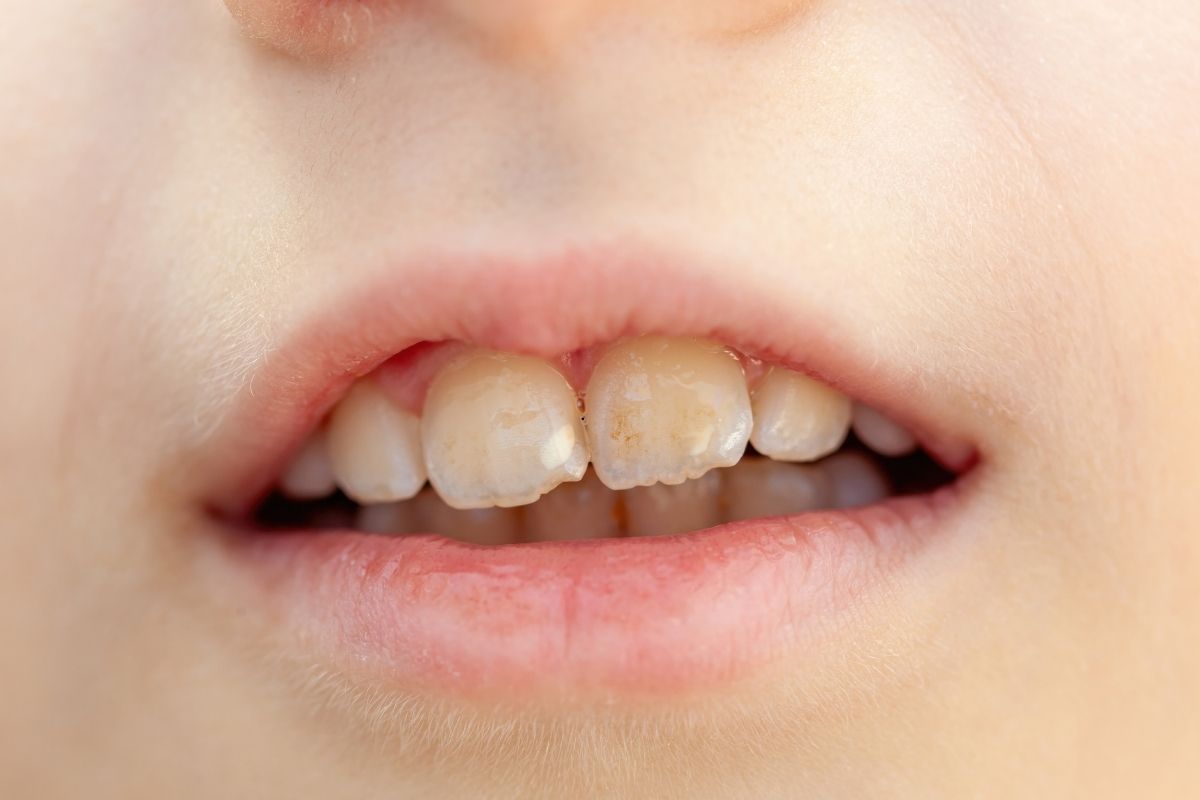 Prevent and Treat White Spots on Teeth | Expert Dental Advice