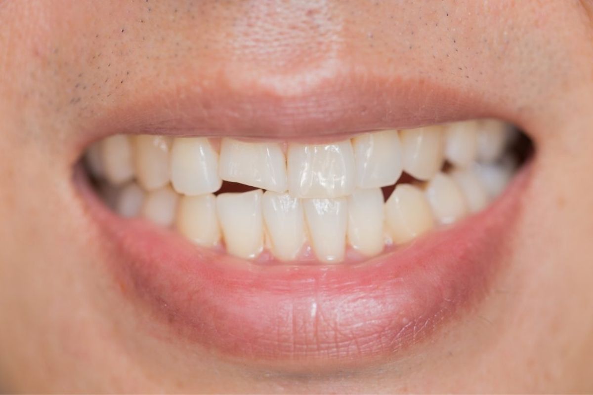 Cracked vs Chipped Teeth: How to Tell the Difference