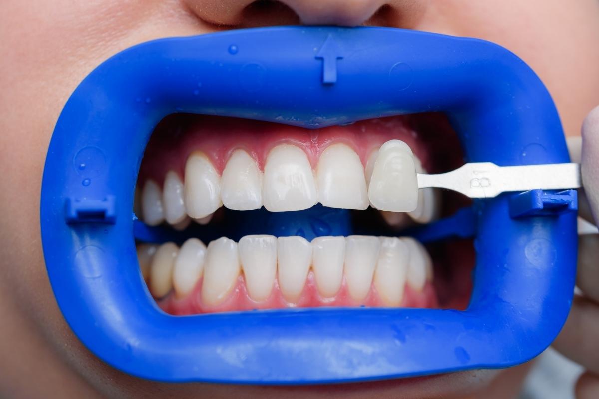 Professional teeth whitening