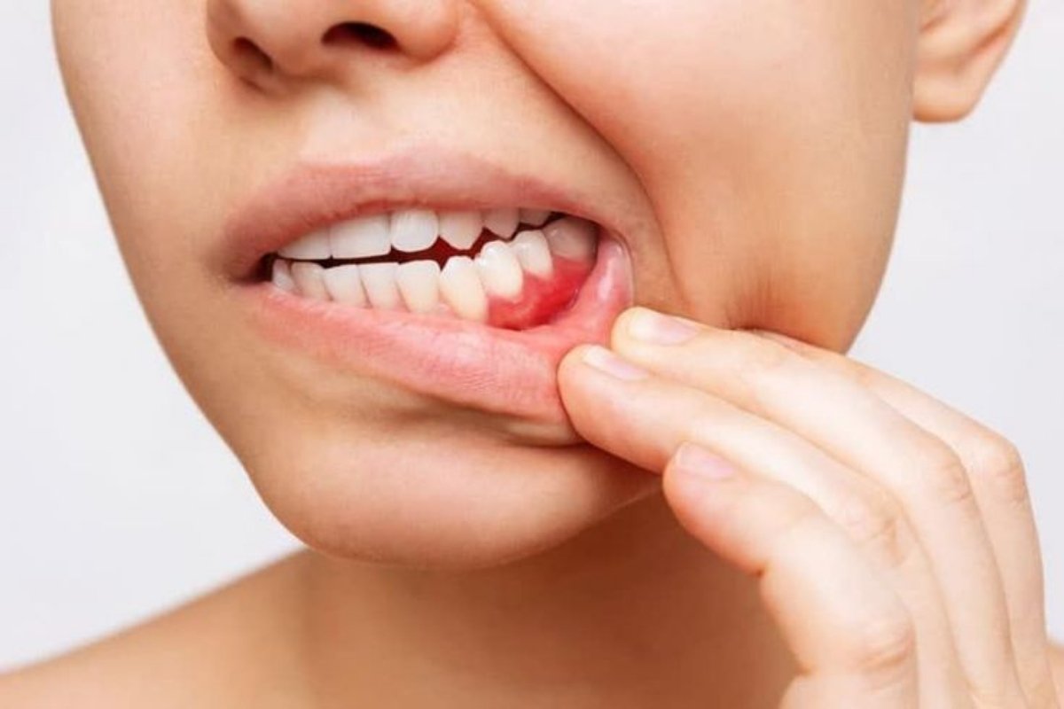 Warning Signs of Periodontal Disease