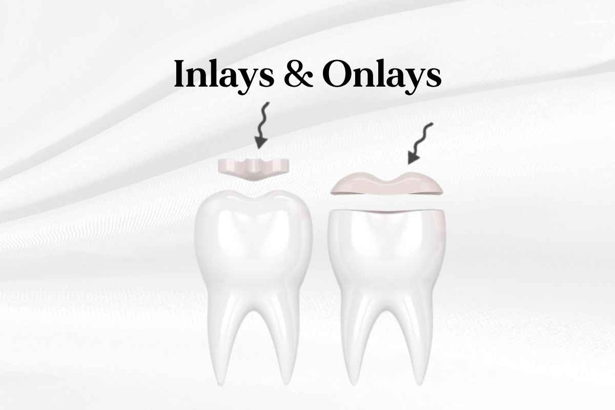dental inlays vs onlays