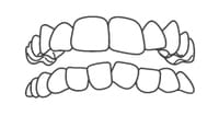 Illustration of upper and lower teeth showing dental alignment and bite relationship for orthodontic reference.