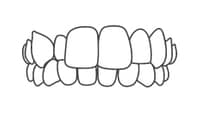 Dental braces shown on upper and lower teeth in orthodontic treatment illustration.