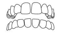 Illustration of upper and lower teeth showing dental alignment and bite arrangement.