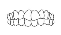 Frontal view of upper and lower teeth showing proper alignment and bite position.