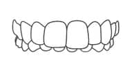 Dental prosthetic illustration showing a full upper arch denture or false teeth set against white background.