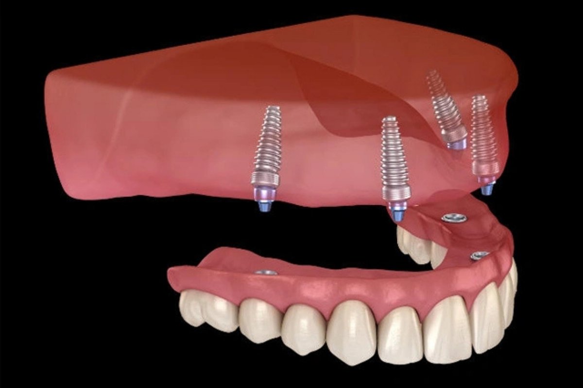Snap-in Implant Dentures