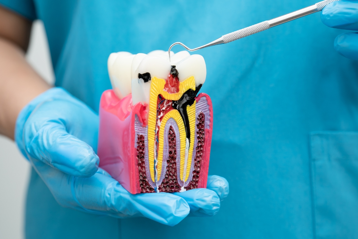 How to Tell If You Need a Root Canal Before the Pain Gets Worse