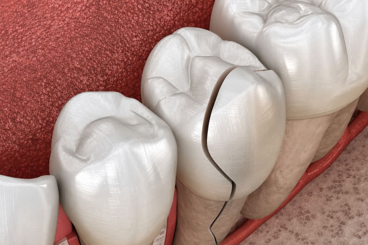 How Dentists Treat Cracked Teeth Without Removing the Tooth