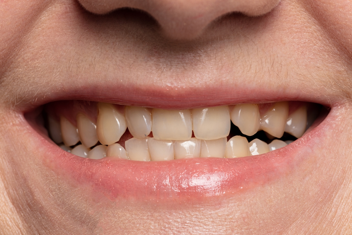 Can Yellow Teeth Become White Again Naturally or at the Dentist
