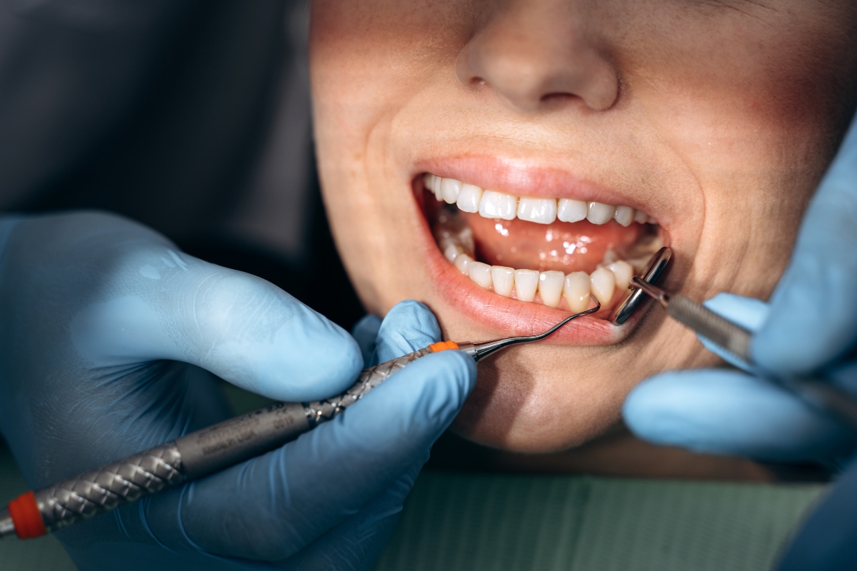 Does Dental Cleaning Remove Stains or Just Plaque