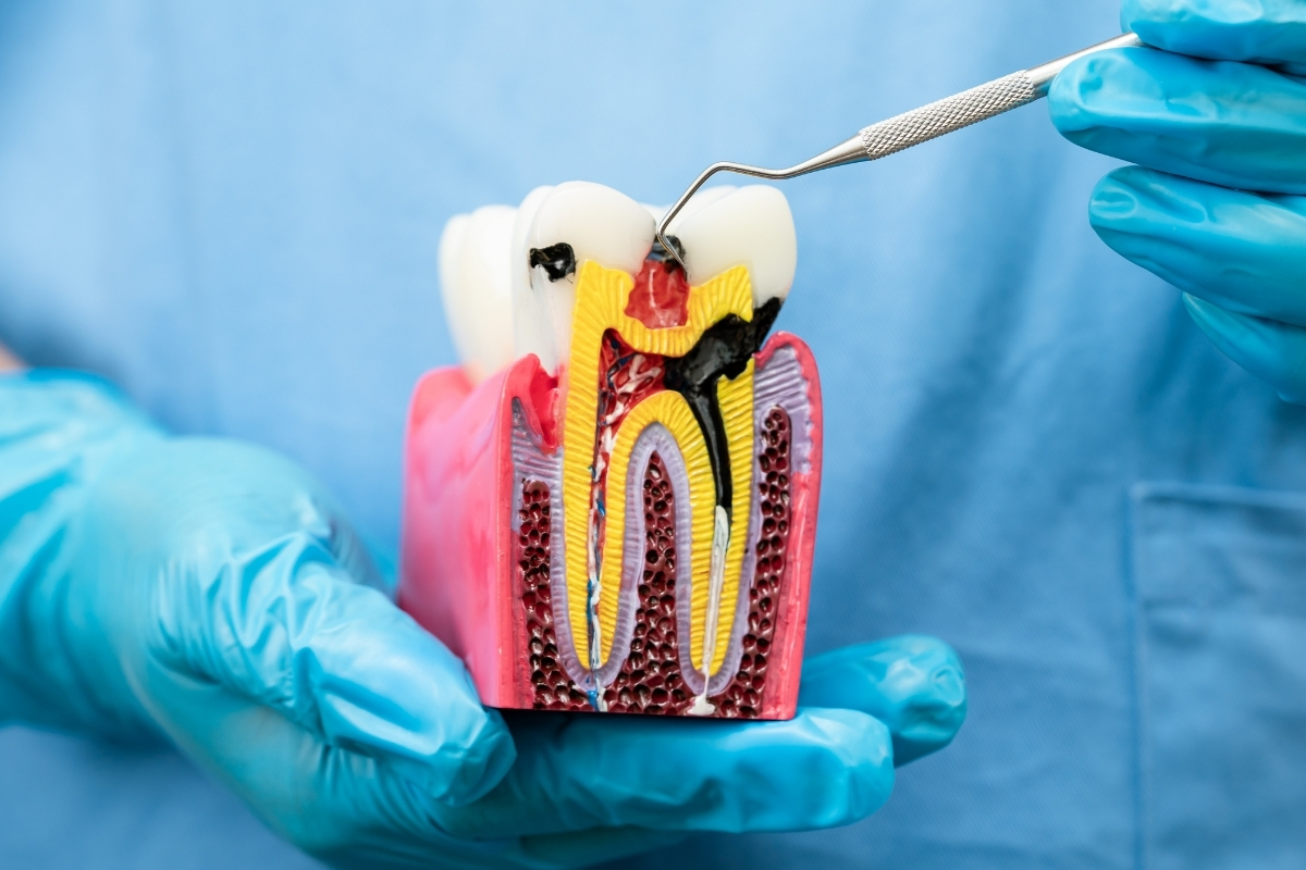 Root Canal Treatment in Oceanside