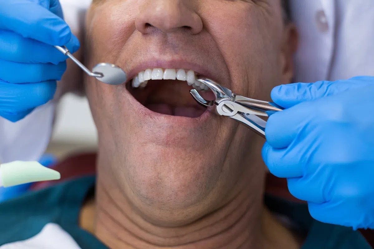 A Dentist PullTooth Extraction in Oceanside performed by a dentist during a dental procedure.