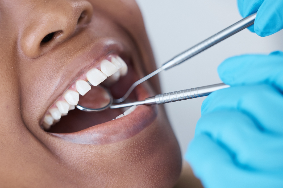 Which Cosmetic Dental Procedure Is Best for Gaps in Teeth